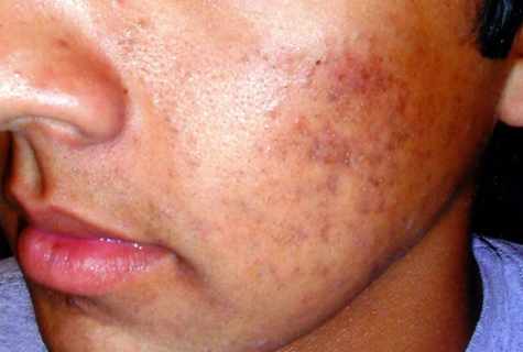 How to treat pigmental spots